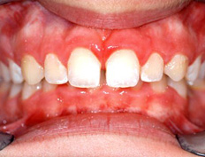 This patient had lower front teeth hitting into the palate. Treatment with full braces was started at age 12 and was finished in 24 months.
