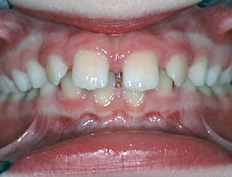 The patient was treated in two phases. In the first phase a growth modification appliance was used to advance the lower jaw. In the second phase full braces were applied at age 13 for 1¼ years to close the spaces. A bonded retainer helps keep the top front space closed.